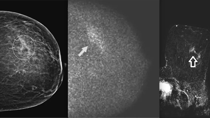 PHOTO GALLERY What does breast cancer look like on mammography